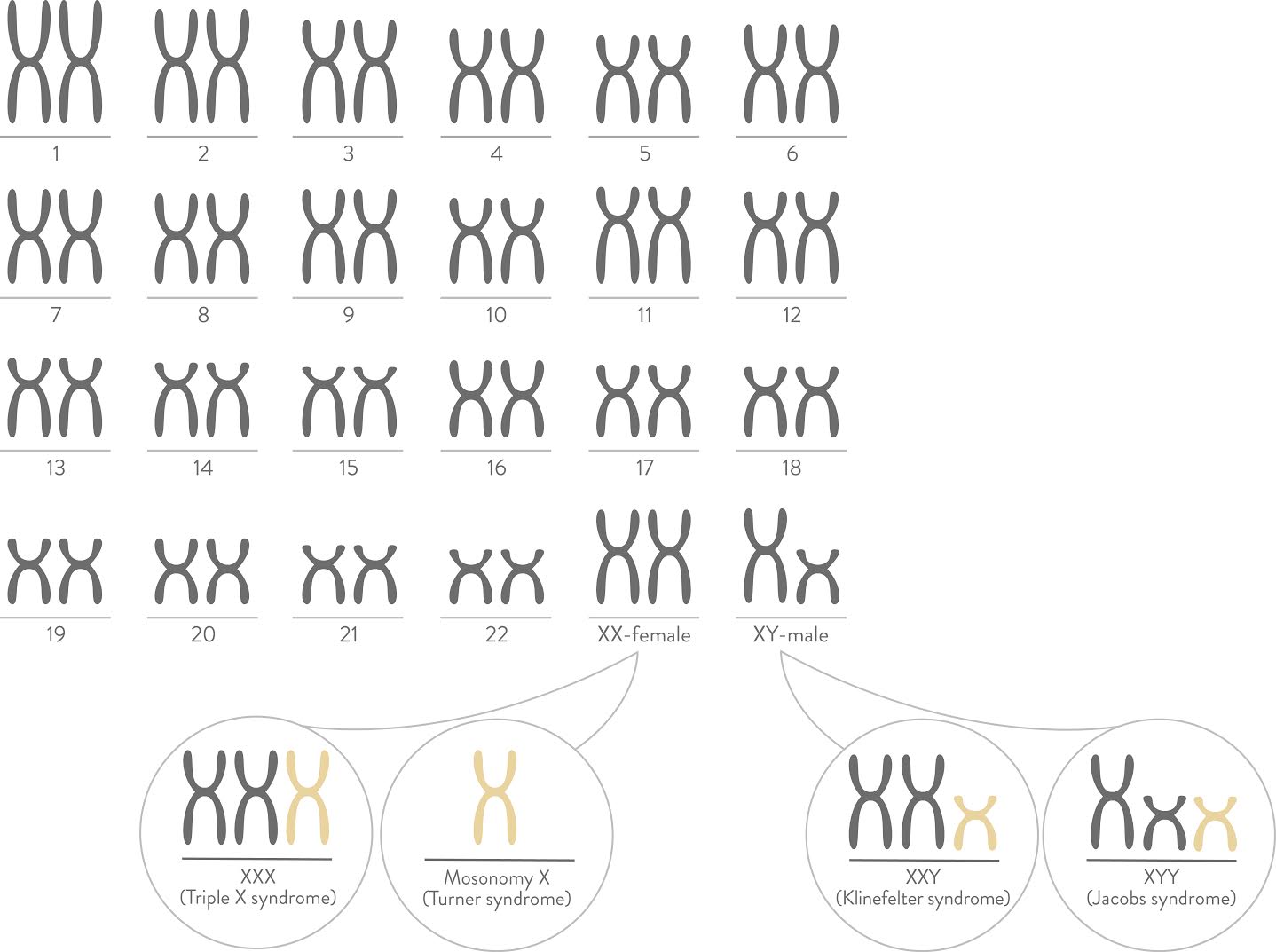 Chromosome diagram of sex chromosome conditions: Triple X (XXX), Turner syndrome (Monosomy X), Klinefelter syndrome (XXY) and Jacobs syndrome (XYY)